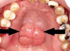 Langit Langit Mulut Ada Benjolan Sakit